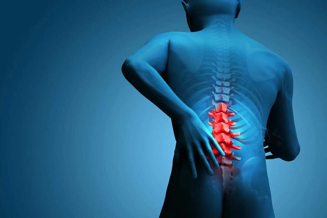 Το κύριο σύμπτωμα της οστεοχόνδρωσης της οσφυϊκής μοίρας της σπονδυλικής στήλης είναι ο πόνος στην πλάτη. 